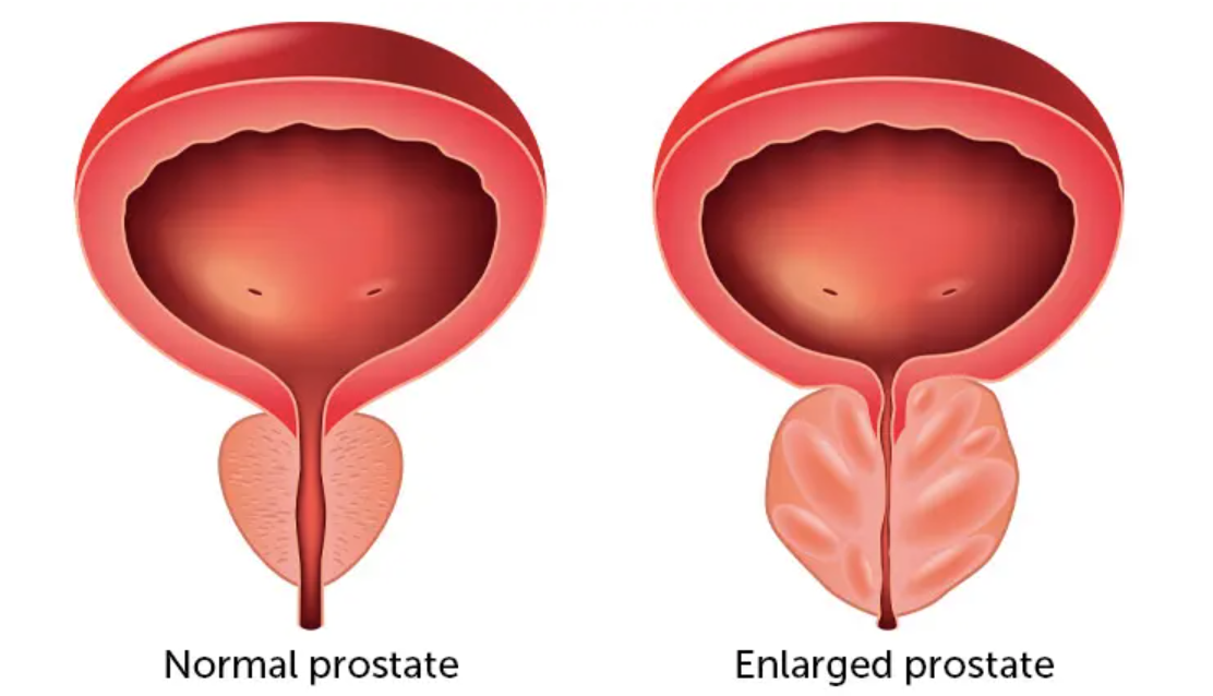 Can Black Seed Oil Tame a Troubled Prostate? Exploring its Anti-Inflammatory Potential